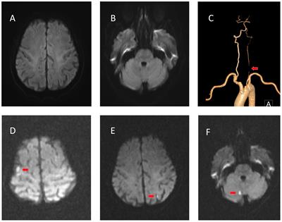 Multiple cerebral infarctions after intravenous immunoglobulin for Guillain–Barré syndrome: two case reports and review of the literature